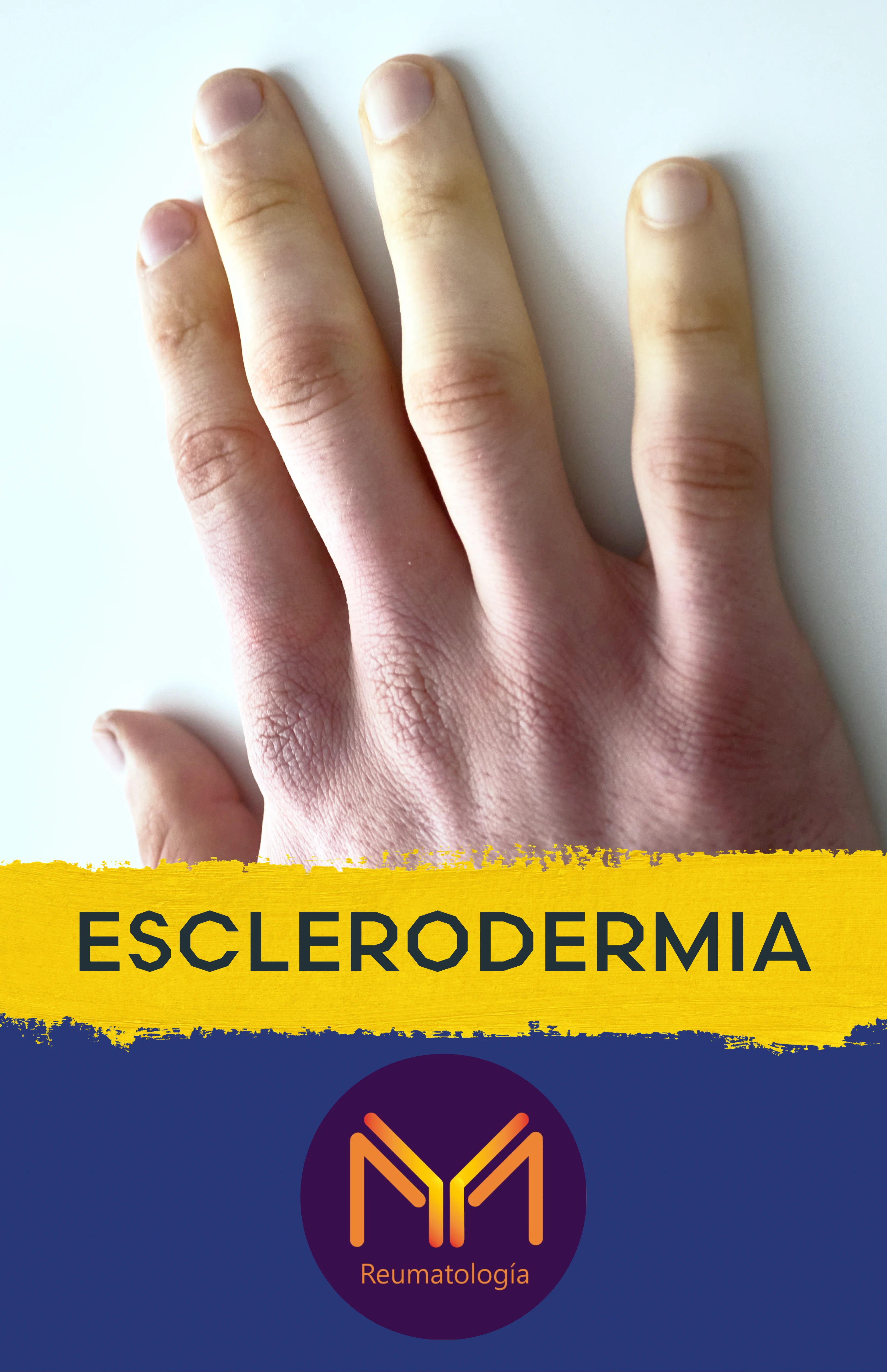 Esclerodermia
