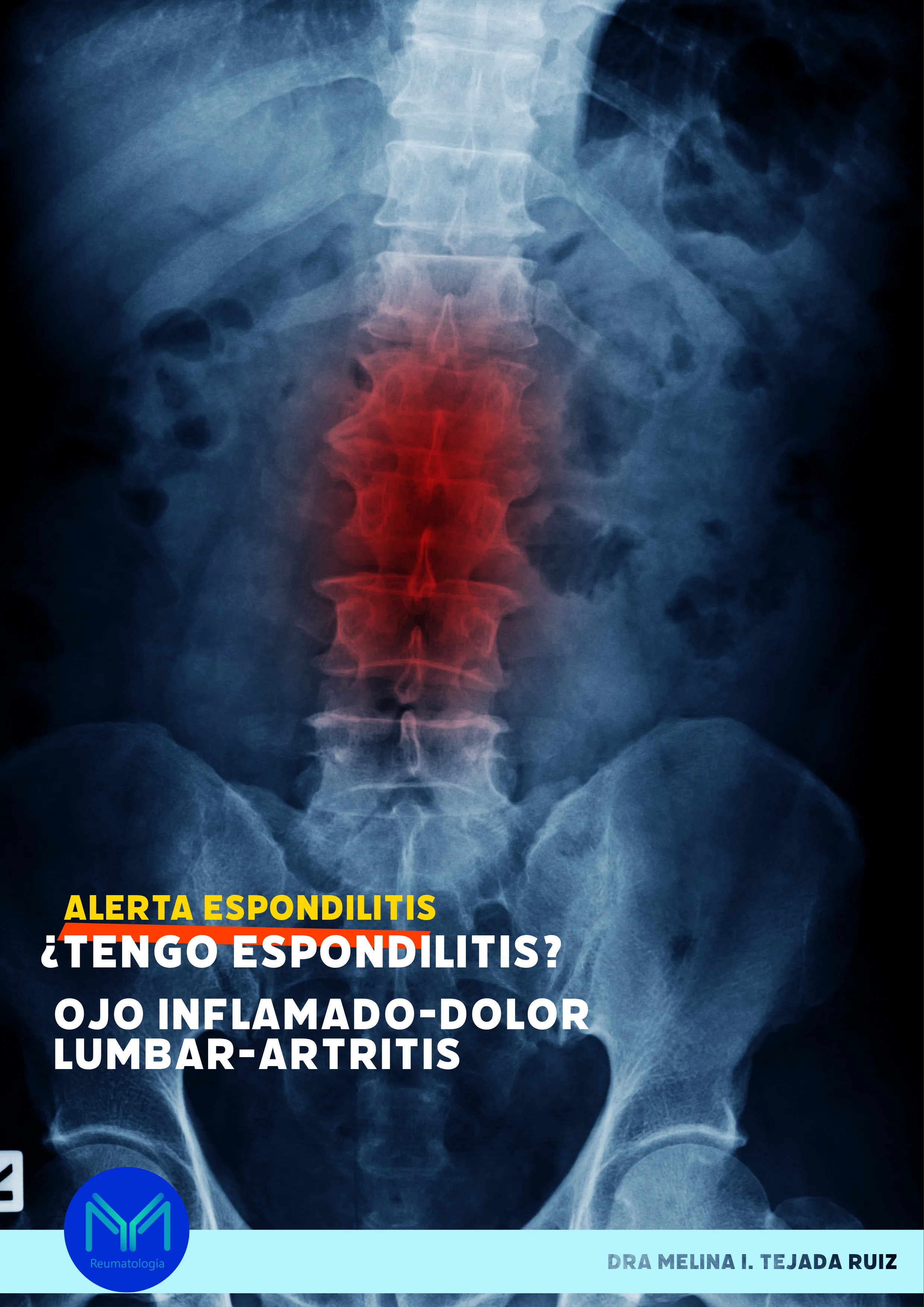 Espondilitis